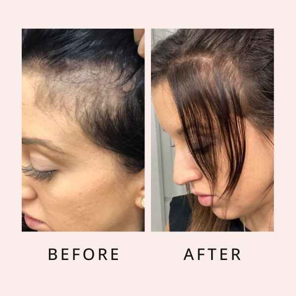 Zovost Hair Growth Serum