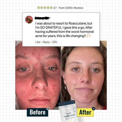 Zovost Acnera Skin Support
