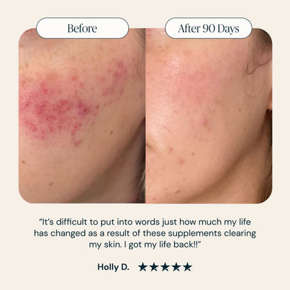 Zovost Acnera Skin Support